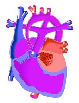 Hypoplastic Left Heart Syndrome